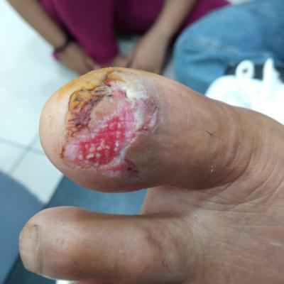 Cuci Luka Diabetes 1
