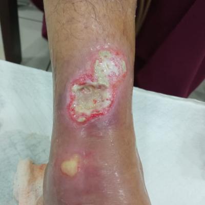 Cuci Luka Diabetes 3