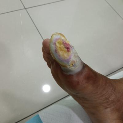Cuci Luka Diabetes 6