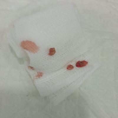 Removal Of Cyst 2