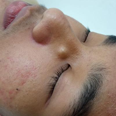Removal Of Cyst 1