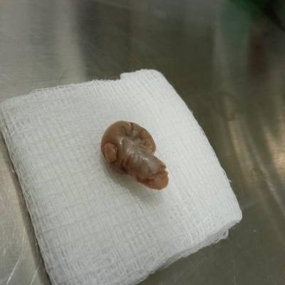 Removal Of Cyst 3