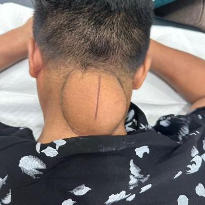 Removal Of Lipoma 1