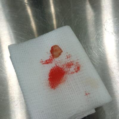 Removal Of Warts